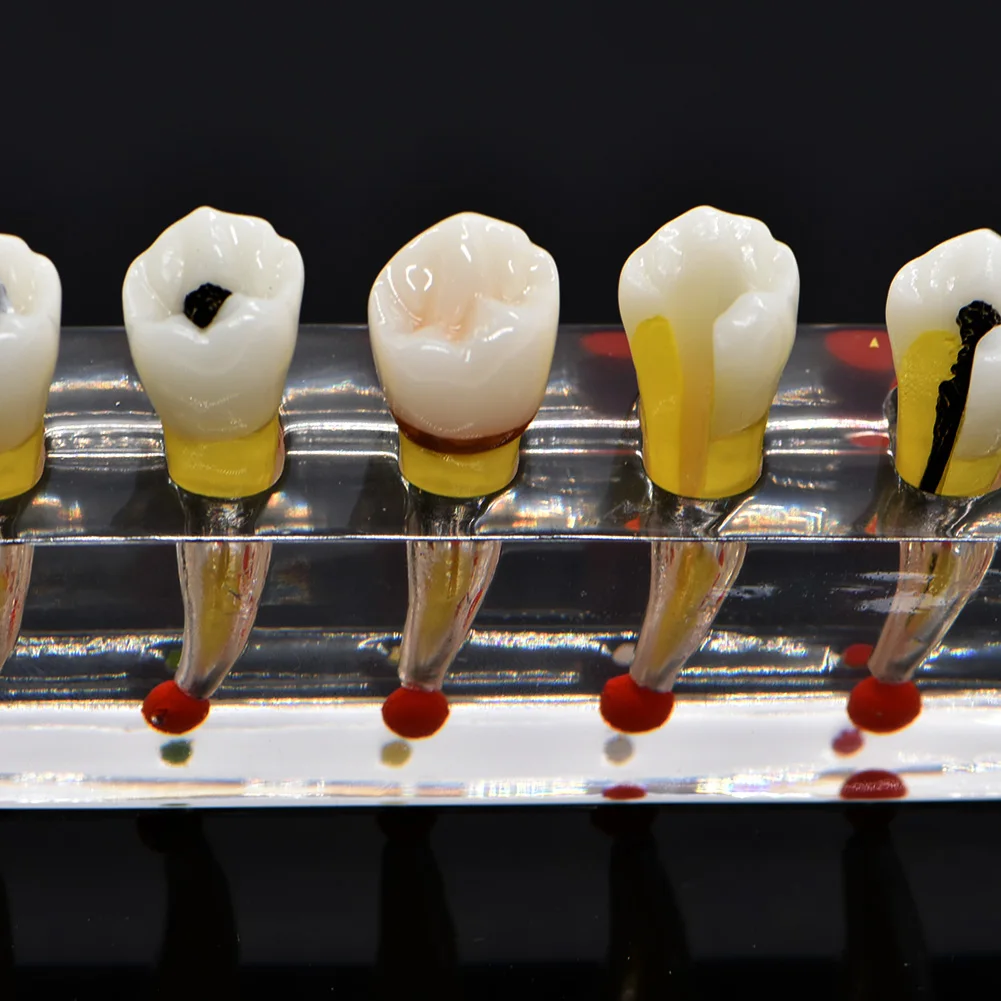 Endodontic patološkega model patologijo Pacienta komunikacijski model Endodontic zdravljenje Posterior Zob Zobna Pulpa Obnova