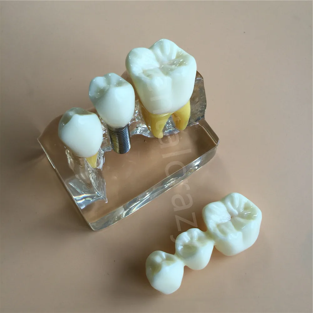 Jasno Zobni Predstavitev Študija Zob Model za Implantacijo Analiza Krono Bridge Model