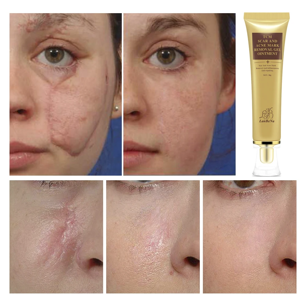 LANBENA Acne Scar Removal Cream Koža Popravila Obraz, Krema za Akne Vložki Zdravljenje Aken Blackhead Kreme za Beljenje Strij, 30 ml