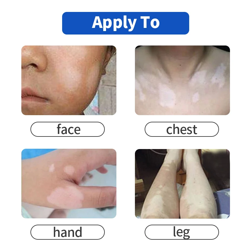 Medicinske Leukoplakia Bolezni Krema Vitiligom Pigment Melanin, ki Spodbujajo Liniment Kožo Belo Mesto Popravilo Zdravljenje mavca