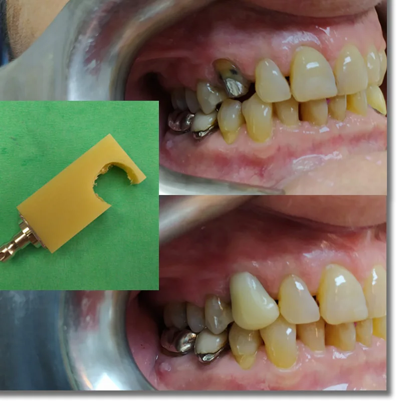 PMMA 10 kosov Sirona 401519mm zobni CAD CAM blok 20 barve za zobozdravnik krono začasno krono most