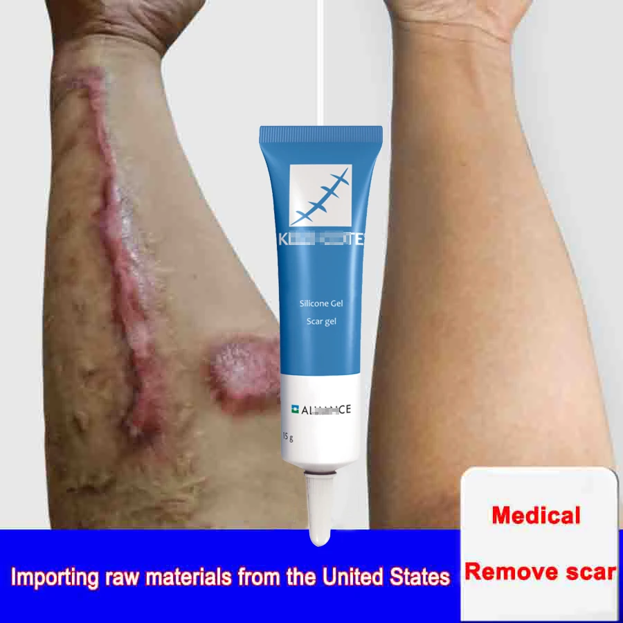 Scar Removal Cream Akne Brazgotine Gel Strij Kirurški Brazgotina Gorijo Za Telo Pigmentacije Korektor Akne Vložki Popravila Za Nego Kože