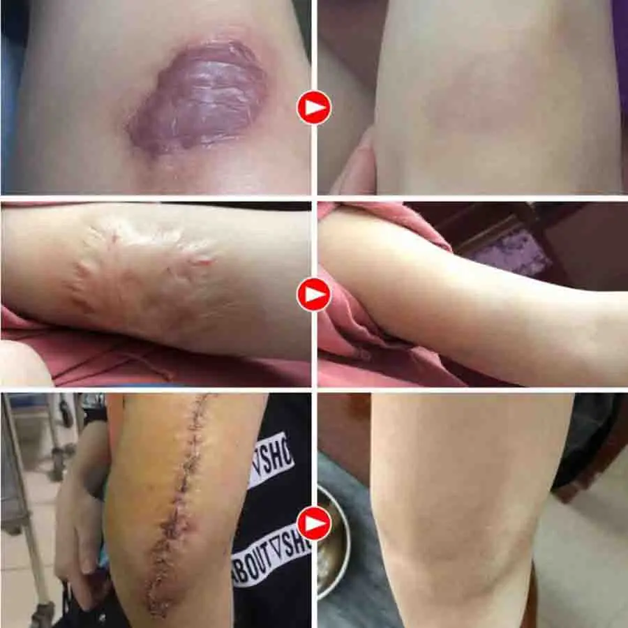 Scar Removal Cream Akne Brazgotine Gel Strij Kirurški Brazgotina Gorijo Za Telo Pigmentacije Korektor Akne Vložki Popravila Za Nego Kože