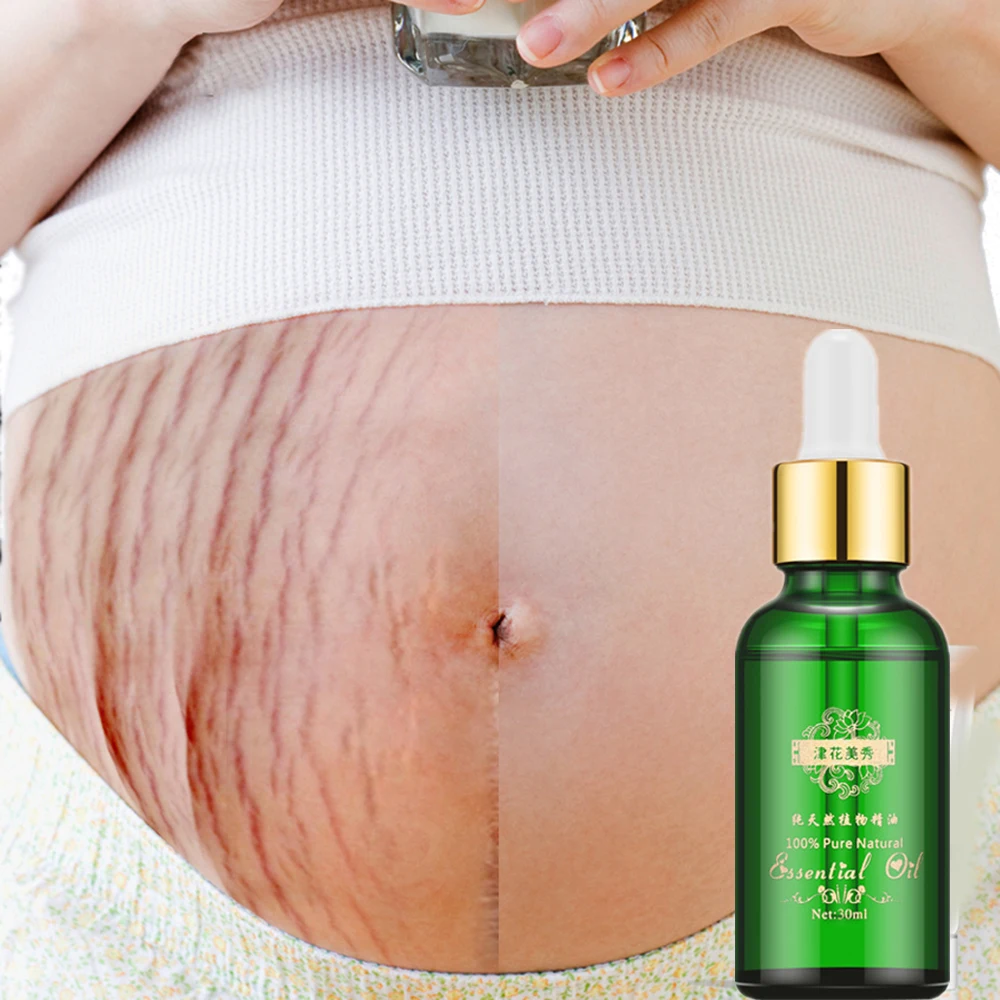Strij Odstranjevalec Eterično Olje, Za Nego Kože, Zdravljenje Kreme Za Strije Odstranitev Porodniškega Slackline Za Nosečnice Olja