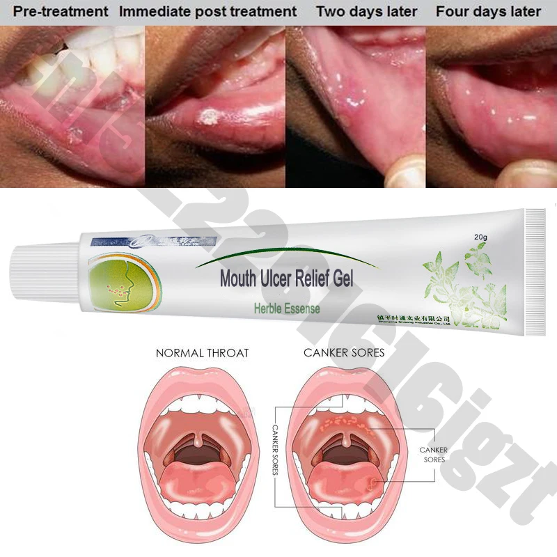 Usta, Razjede Olajšave Gel Naravna Zeliščna Ustna Antibakterijska Krema za Hitro Oprostitev Hude Bolečine & Draženje v 2 minutah
