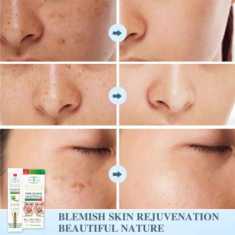 Učinkovito Beljenje Freckle Krema Odstraniti Temne Lise Melasma Acne Spot Pigment Melanin Zob Vlažilni Gel za Nego Kože, 30 g