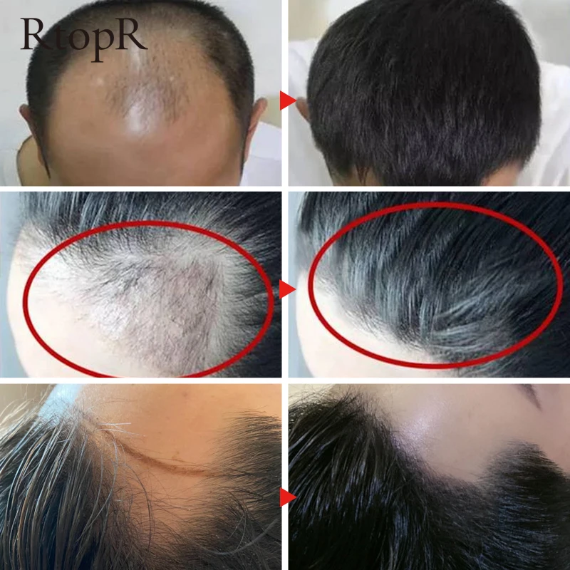 Zeliščni Rast Las Anti Hair Loss Tekoče Spodbujanje Debele Hitro Rast Las Zdravljenja 20ml Eterično Olje Zdravstvenega Varstva Lepoto Bistvo